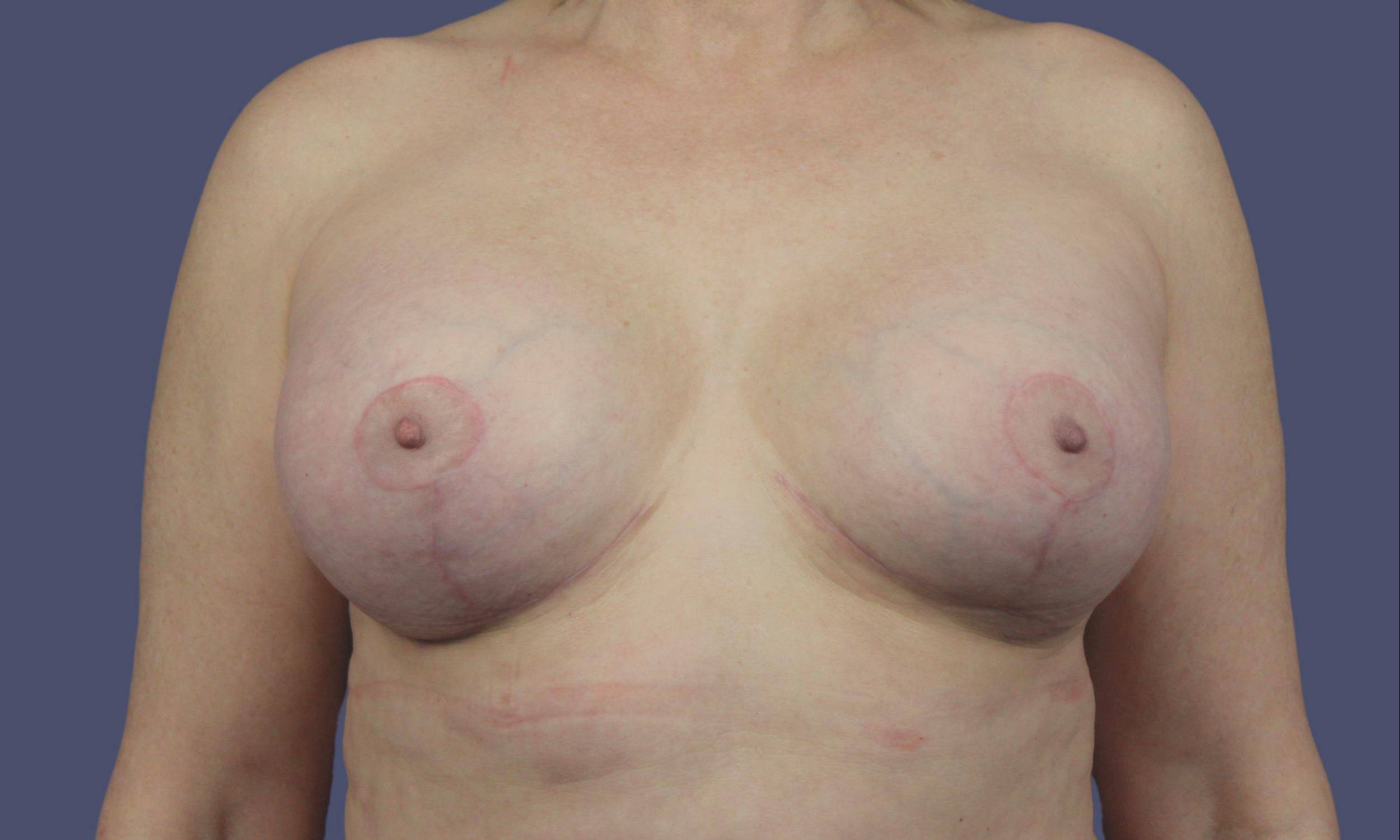 Breast Lift w/ Augmentation 27 After