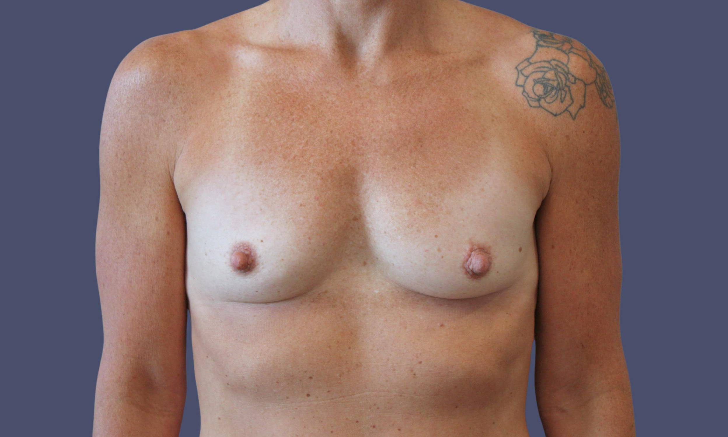 Breast Augmentation 48 Before