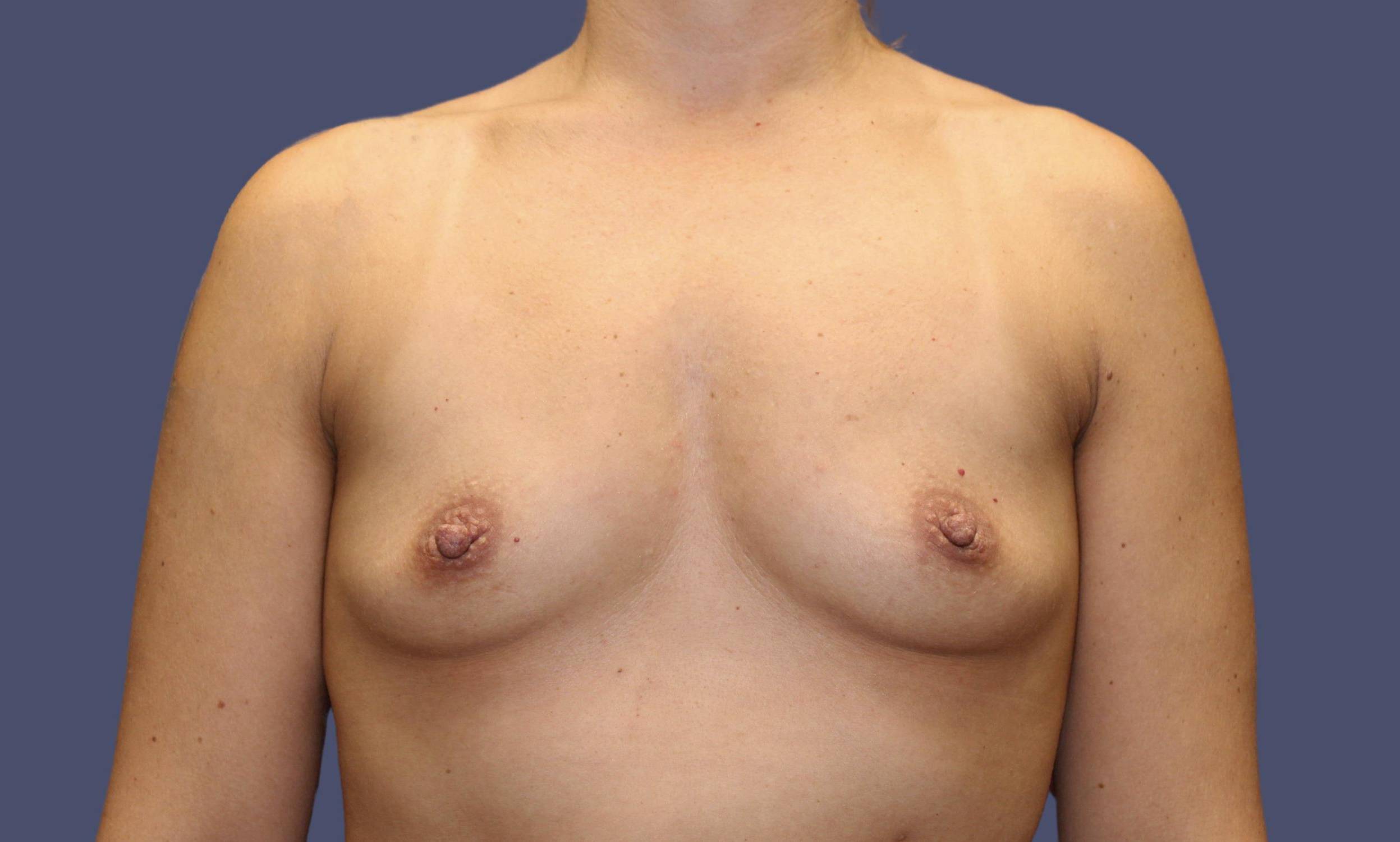 Breast Augmentation 31 Before