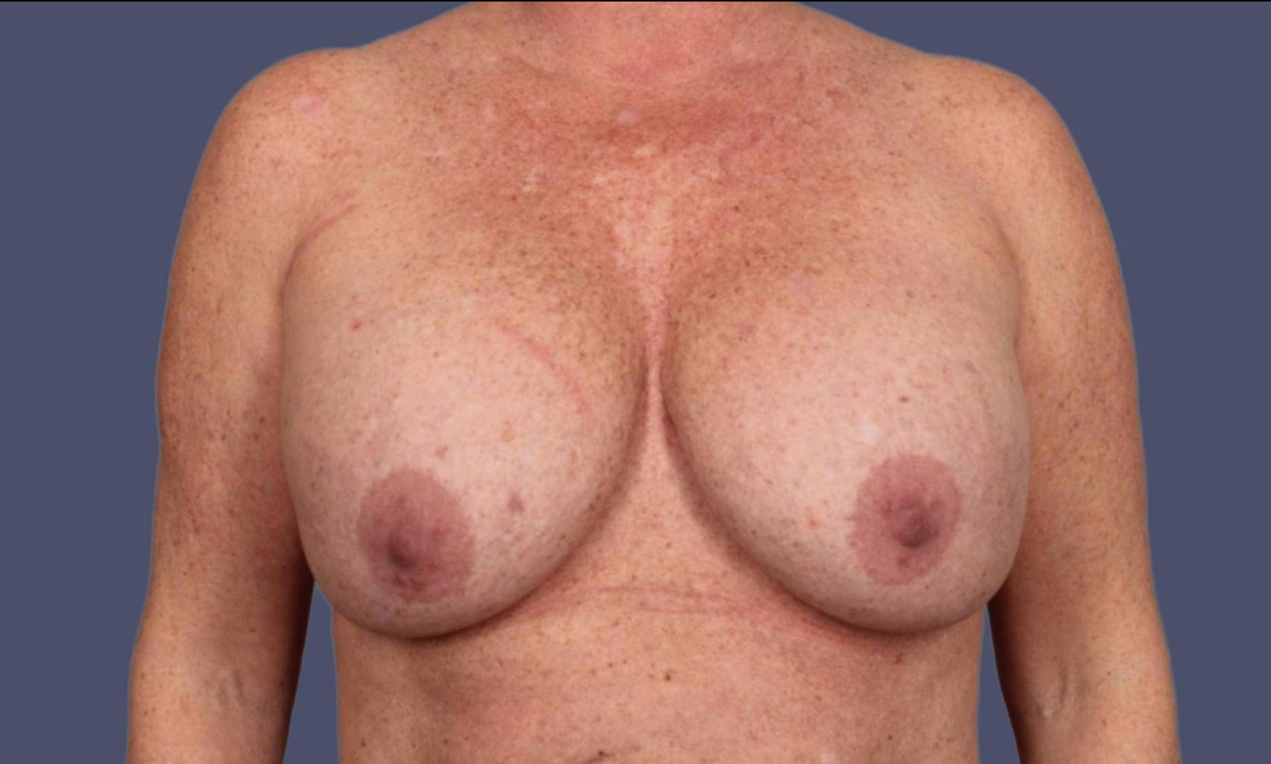 Breast Lift w/Augmentation 19 Before