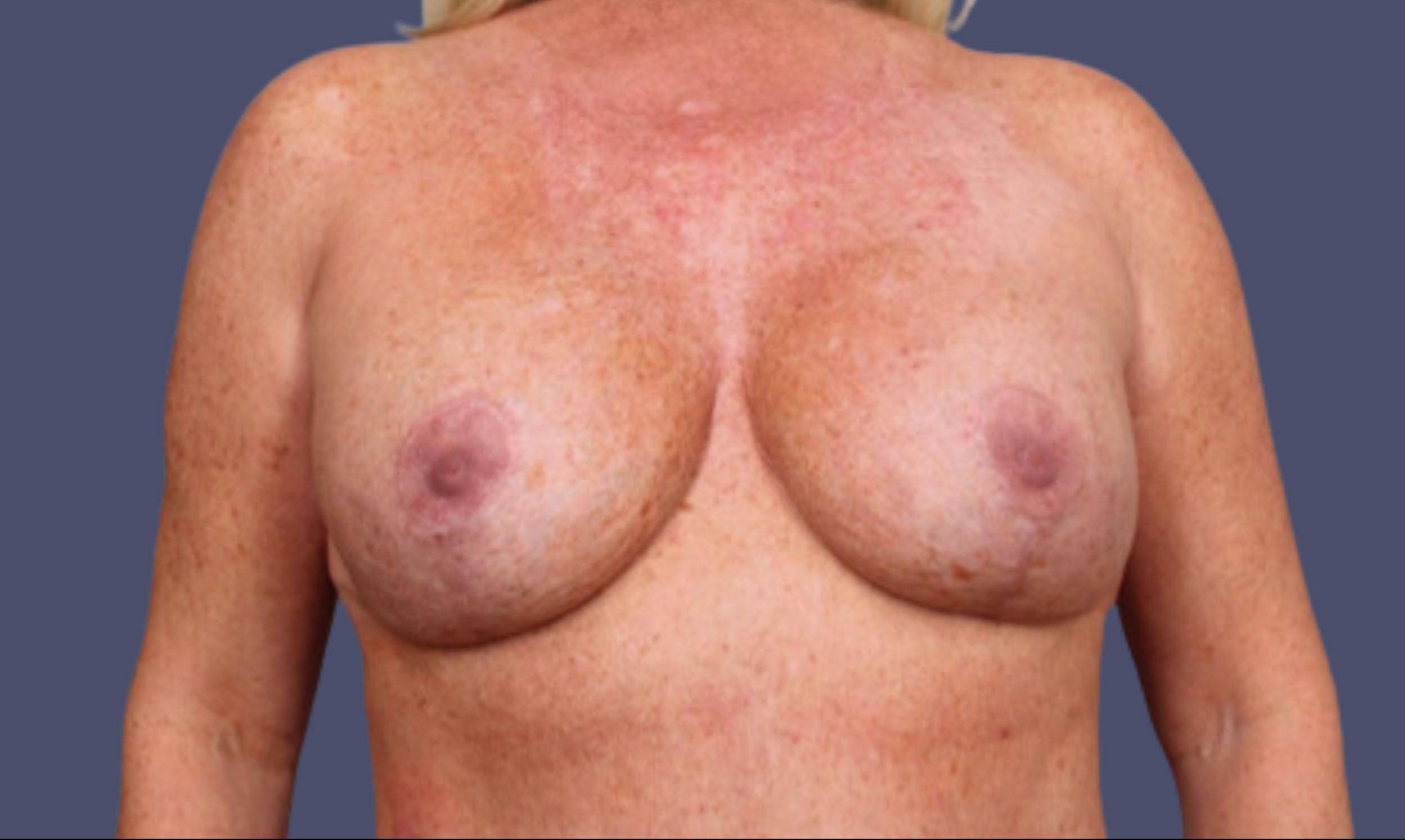 Breast Lift w/Augmentation 19 After