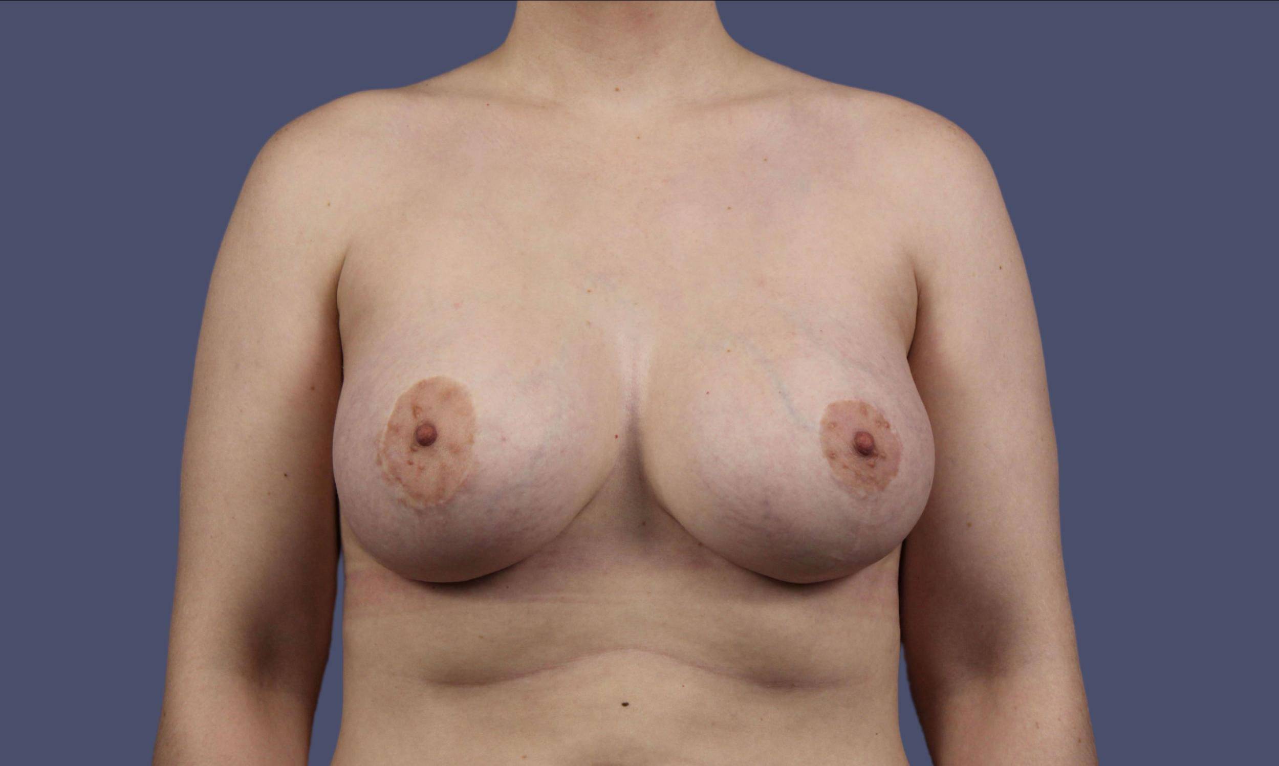 Breast Lift w/Augmentation 21 Before