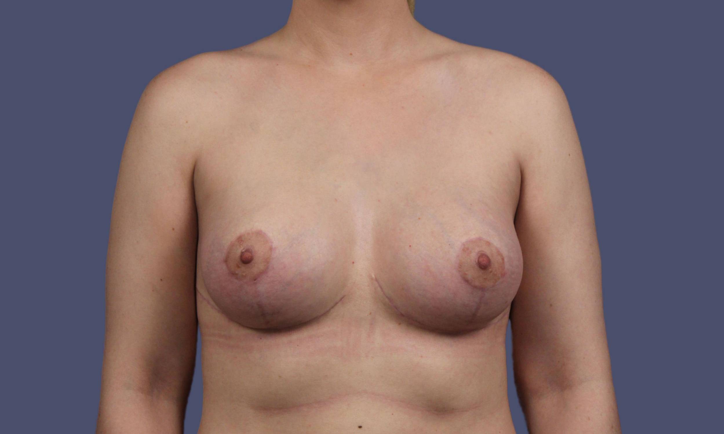 Breast Lift w/Augmentation 21 After