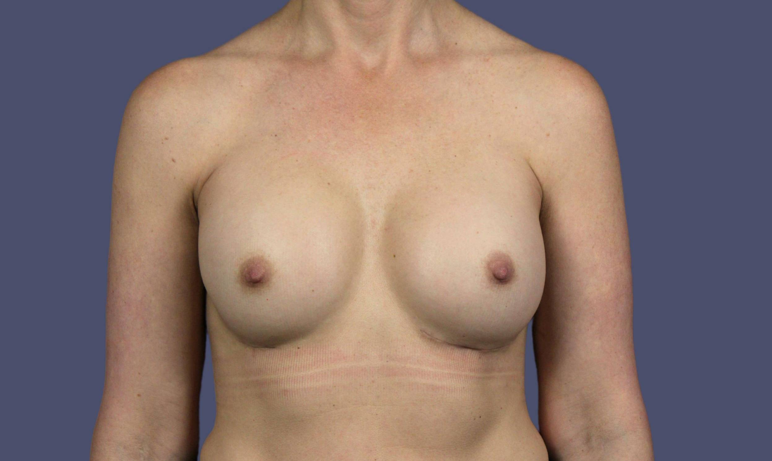 Breast Revision 9 After
