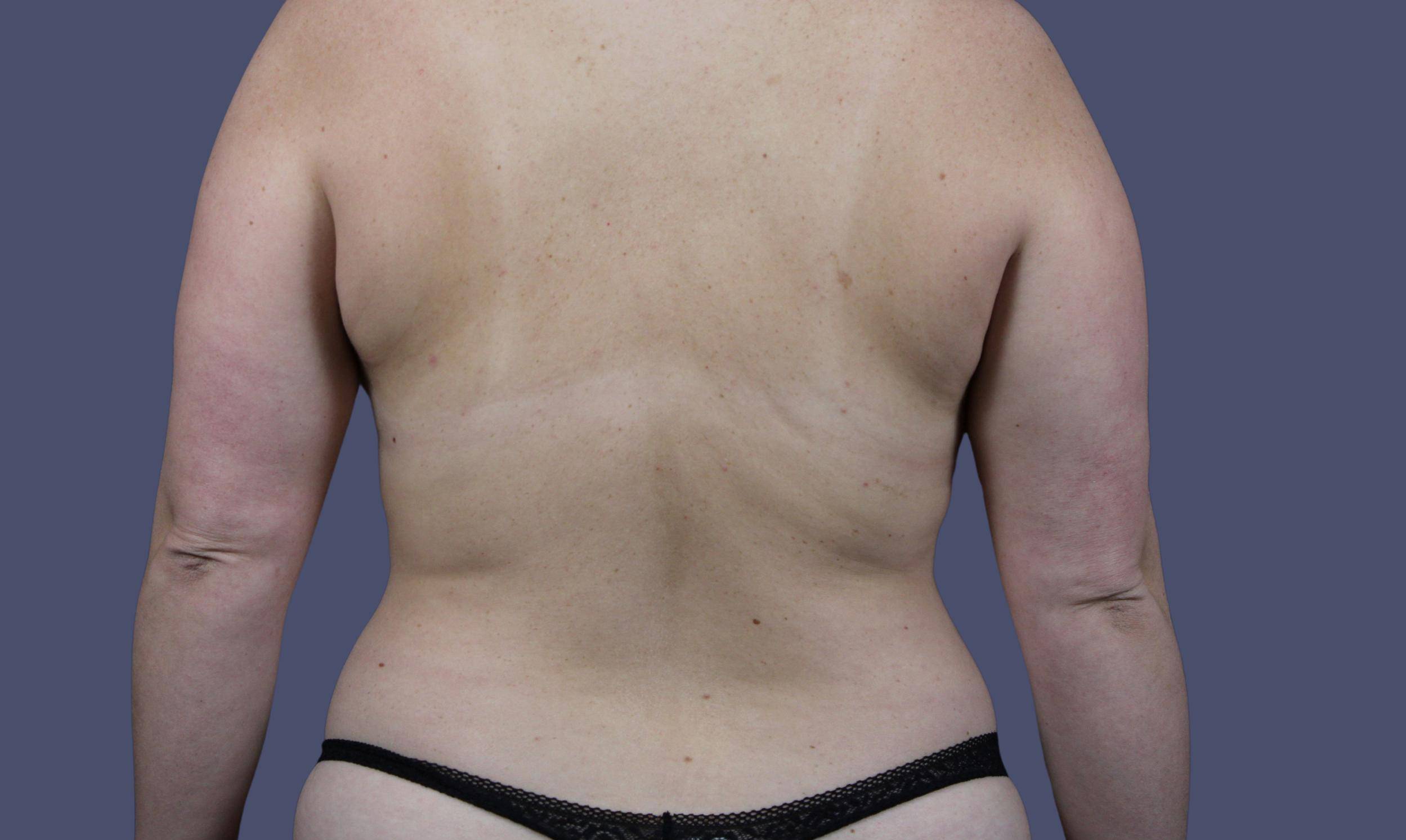 Liposuction 3 - Back & Hips Before