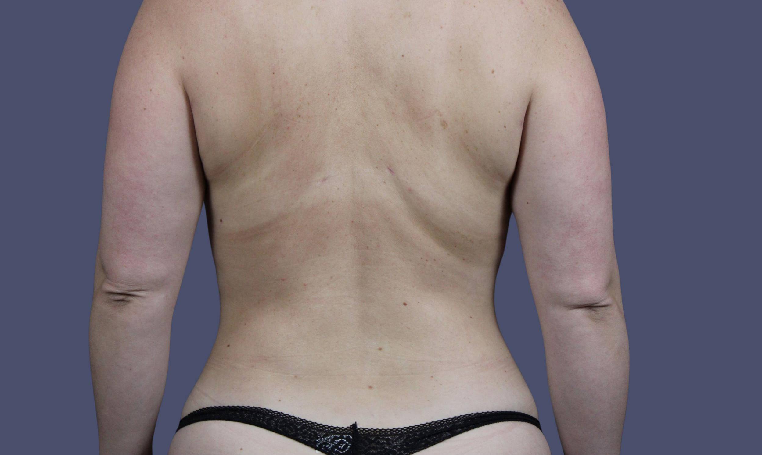 Liposuction 3 - Back & Hips After