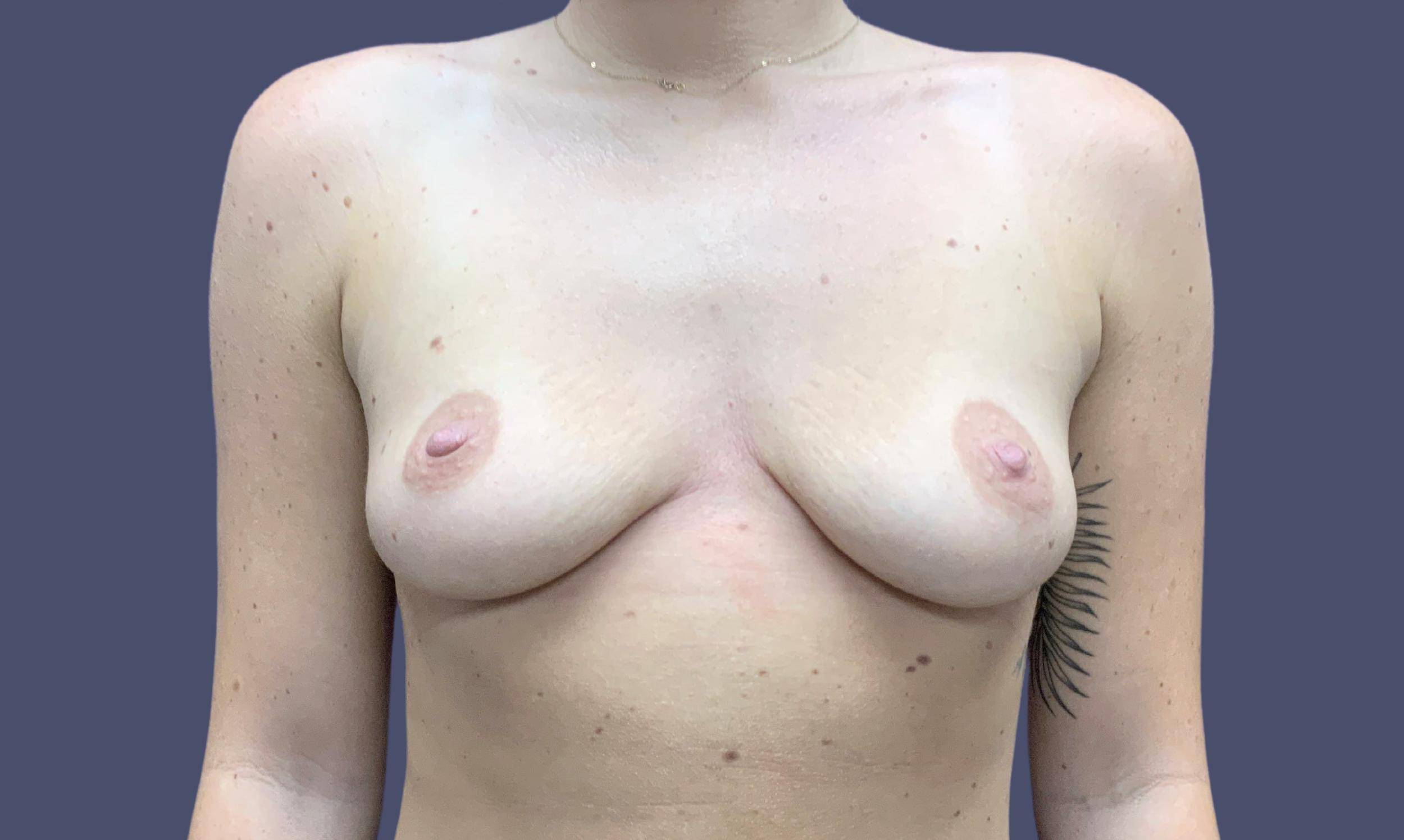 Breast Augmentation 43 Before
