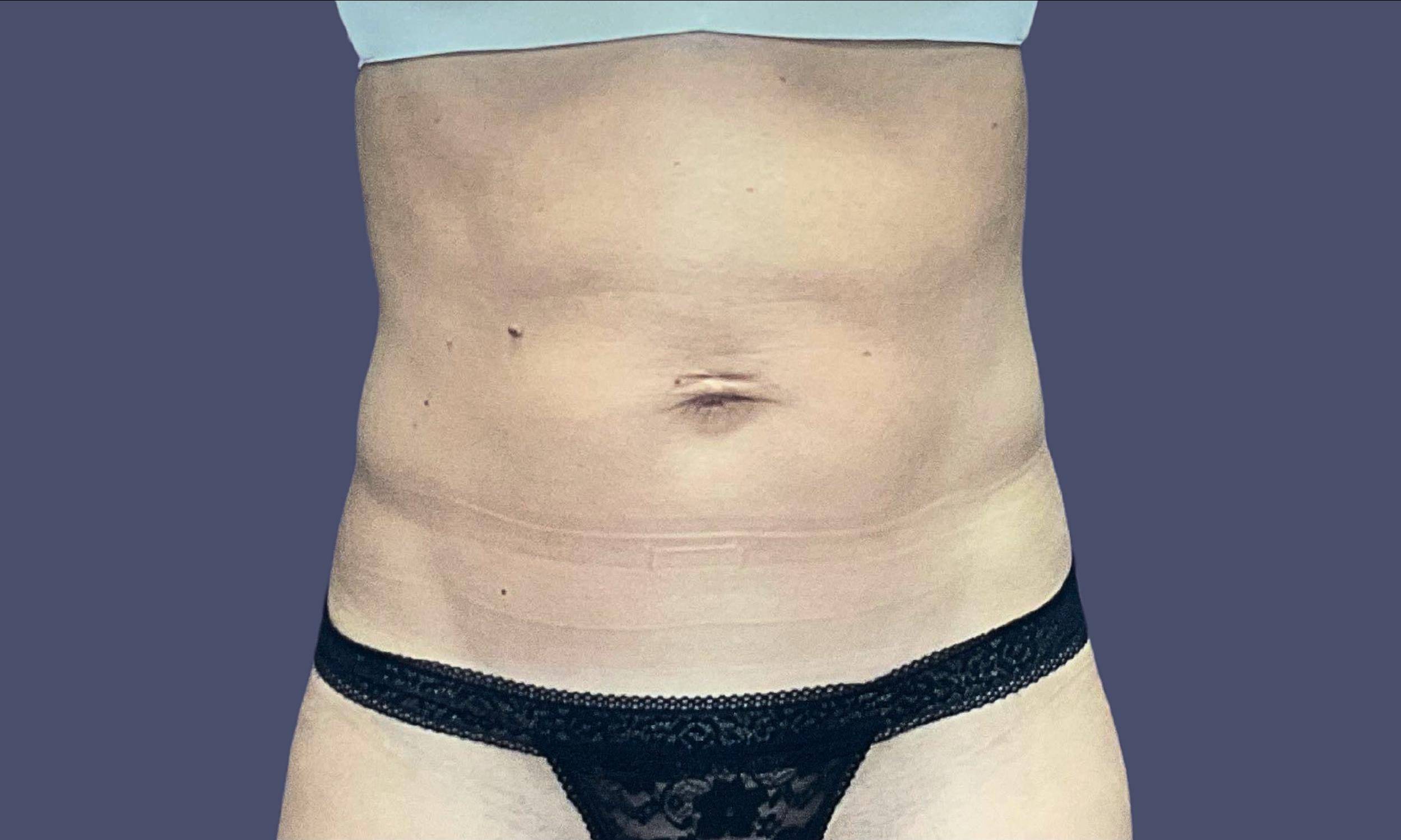Abdominoplasty (Tummy Tuck) 36 Before