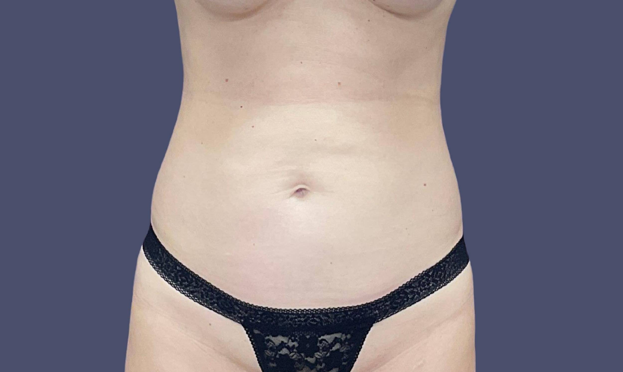 Abdominoplasty (Tummy Tuck) 37 Before