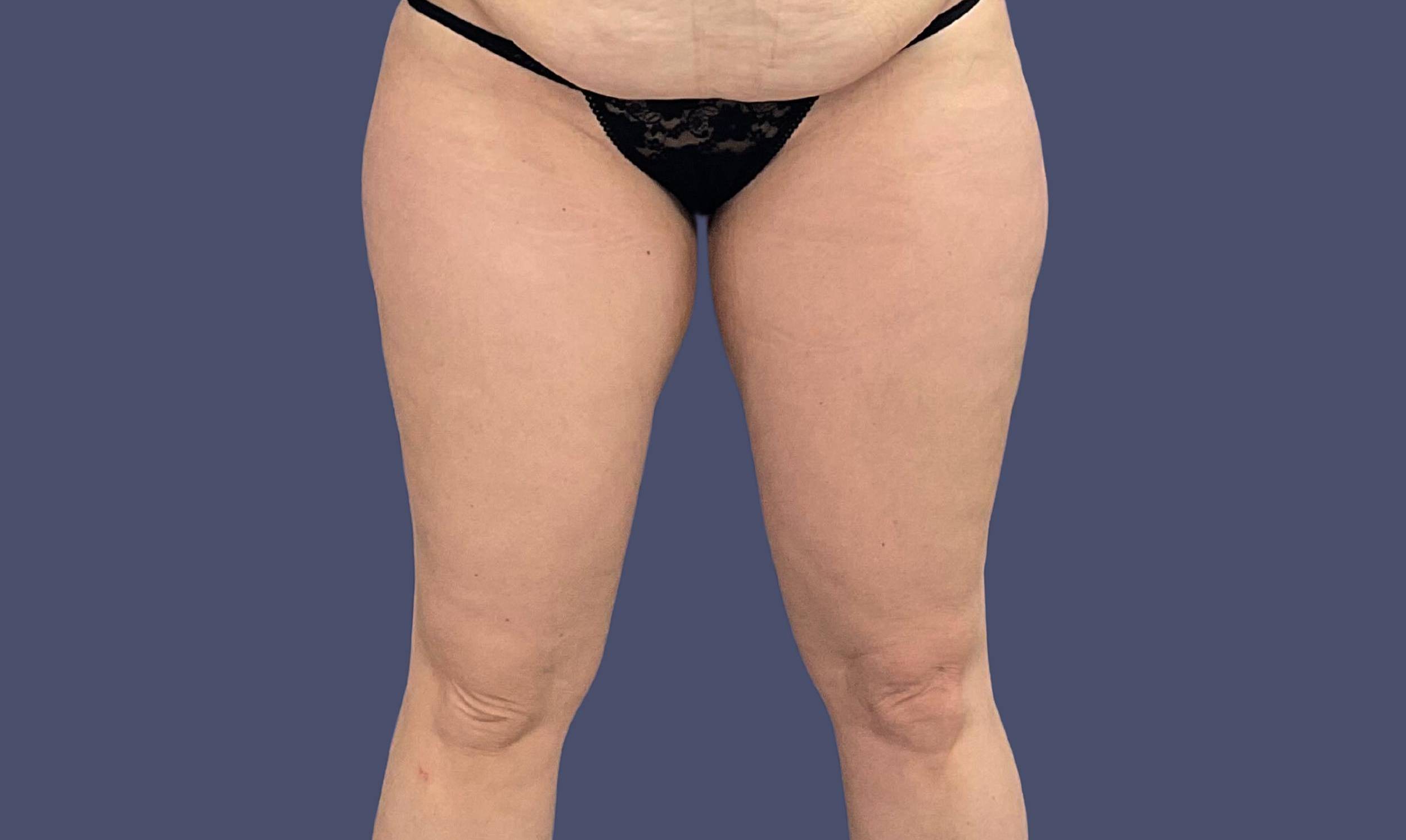 Liposuction 12 - Lateral Thighs Before