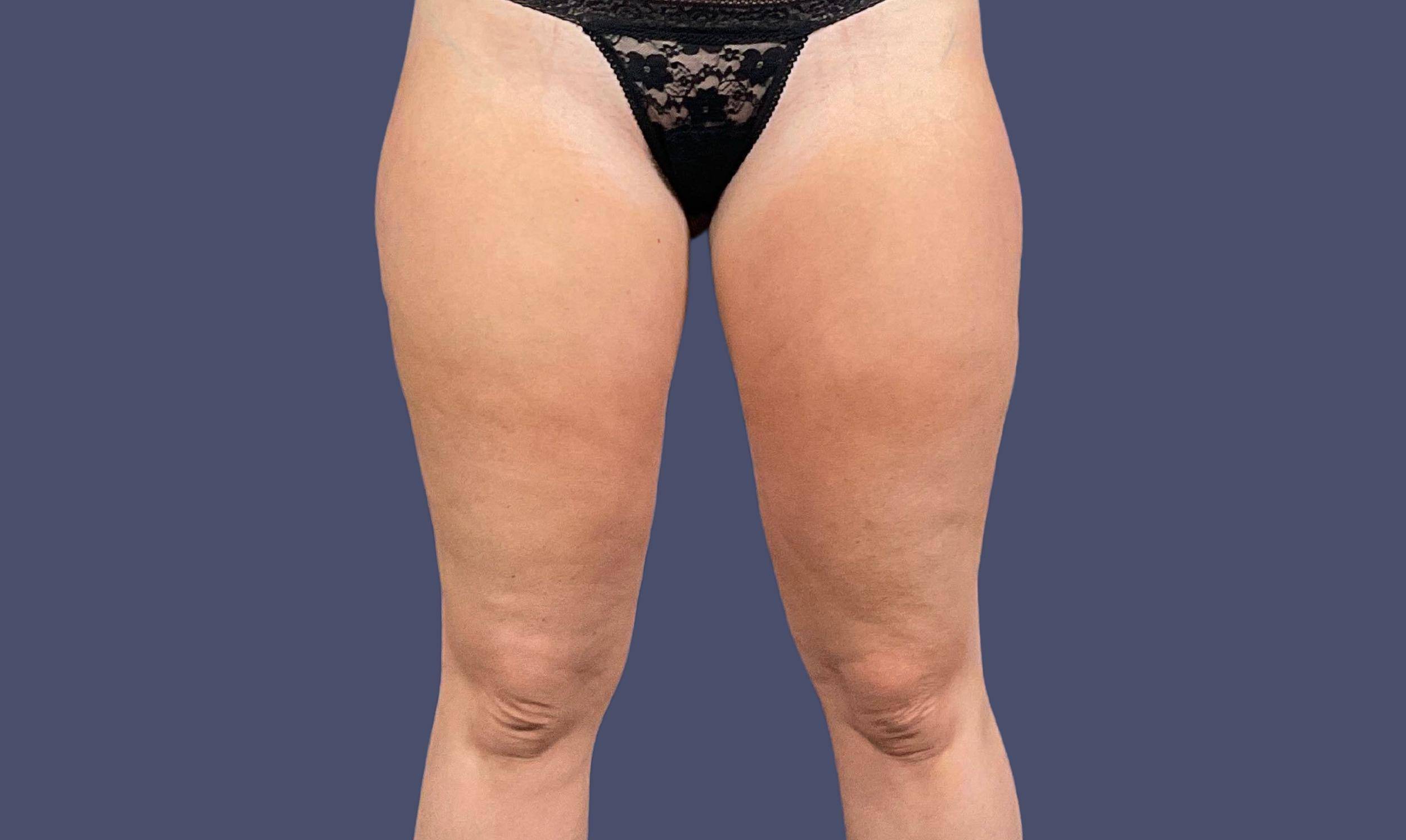 Liposuction 12 - Lateral Thighs After