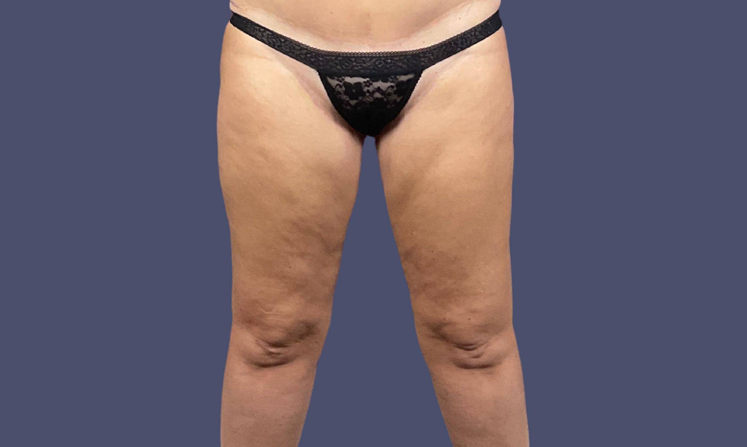 Thigh Lift 5 Before