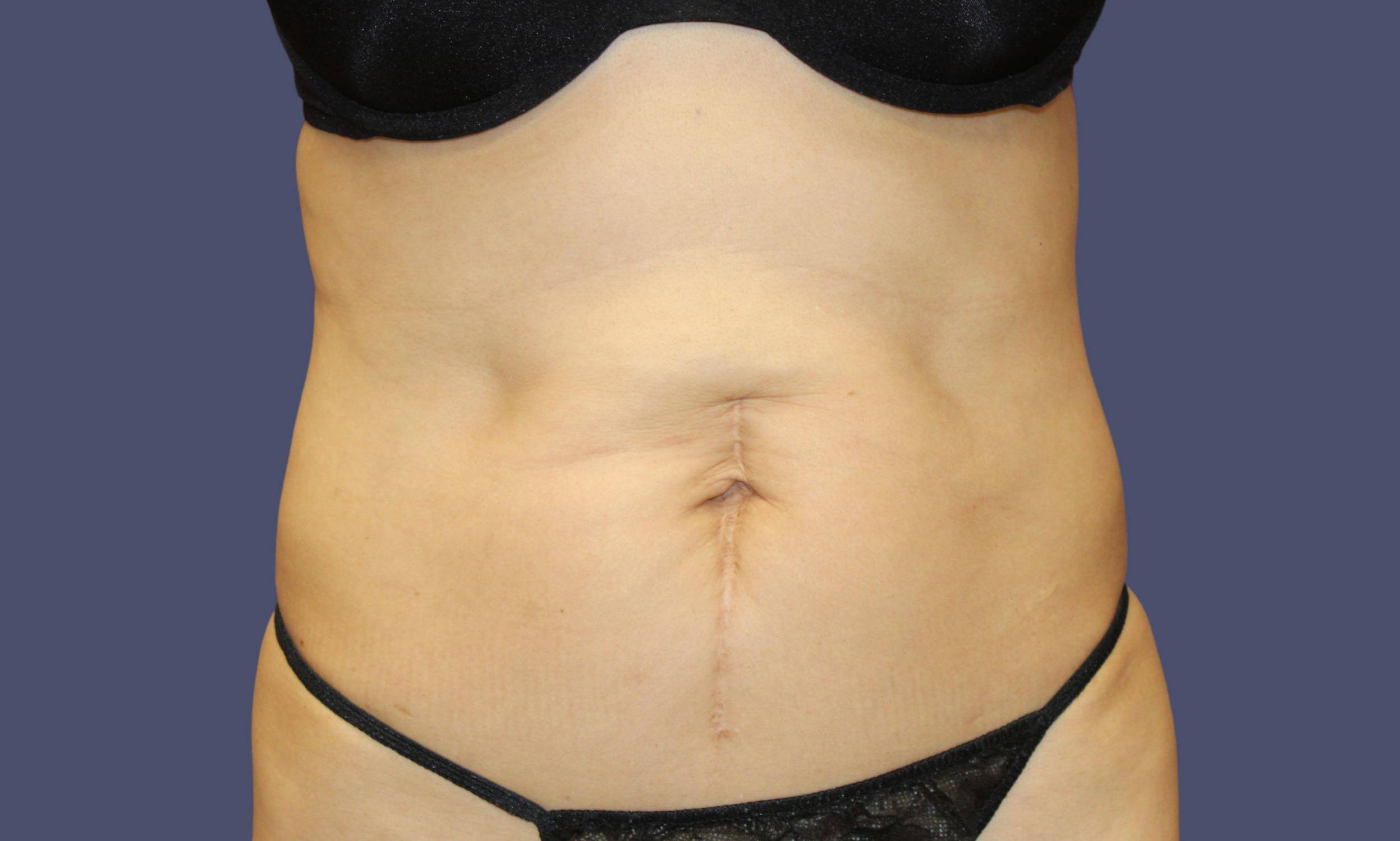 Liposuction 6 - Abdomen & Flanks Before