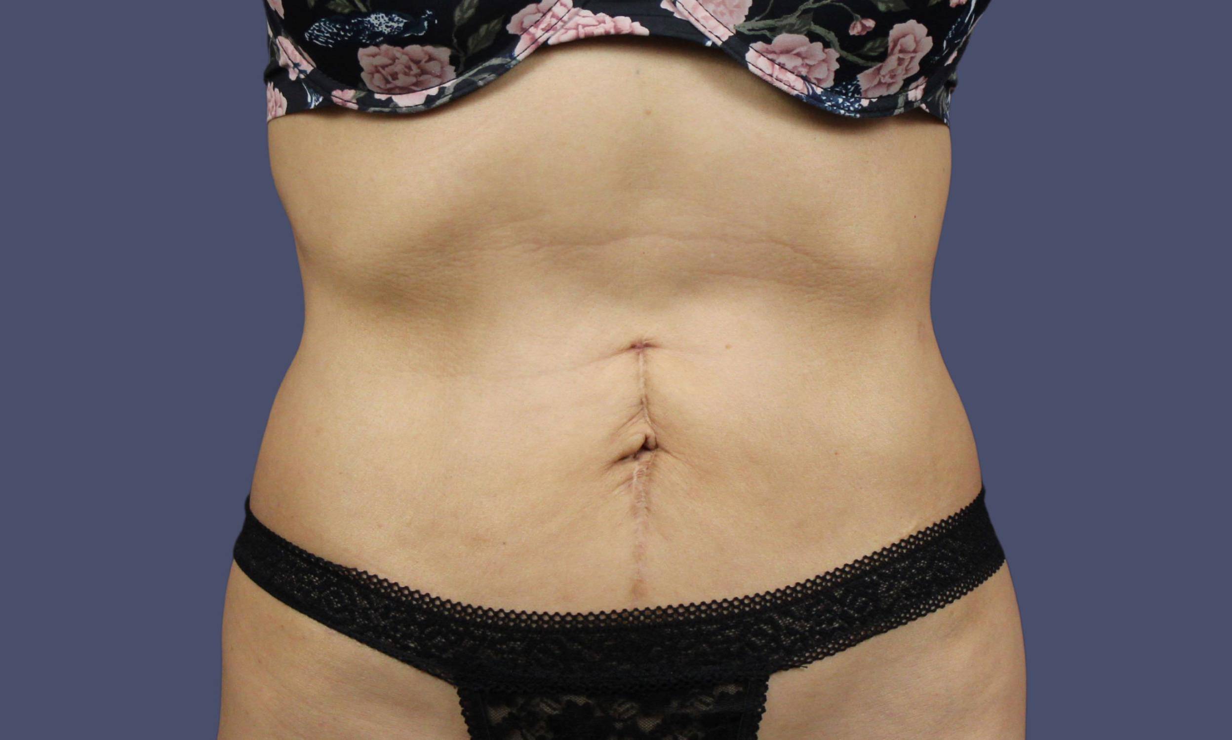 Liposuction 6 - Abdomen & Flanks After