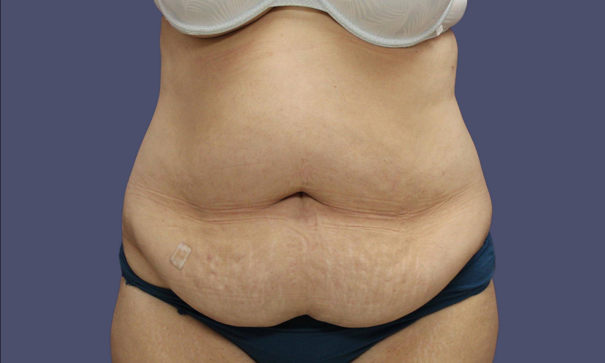 Abdominoplasty (Tummy Tuck) 42 Before