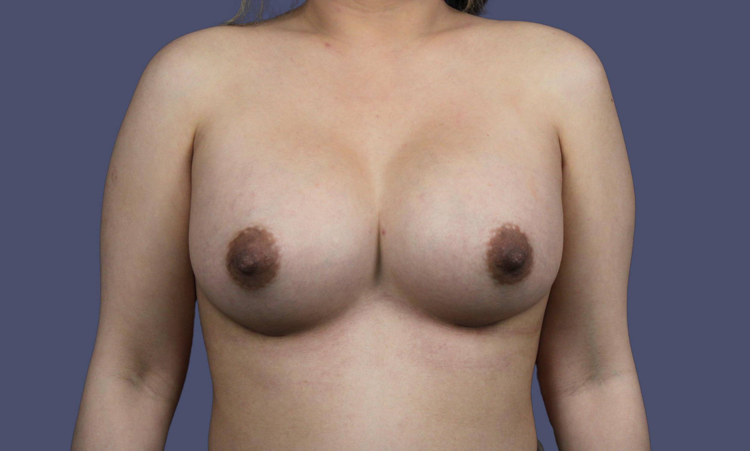 Breast Augmentation 2 After