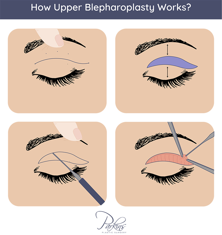 Discover the elegant simplicity of upper eyelid blepharoplasty at Milwaukee, Wisconsin’s Parkins Plastic Surgery.