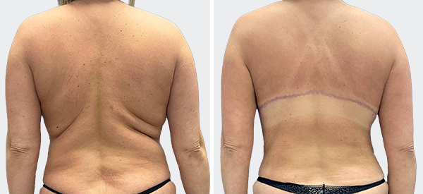 Back and Bra-line Vaser Liposuction - Plastic surgeon doctor