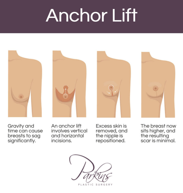 Choosing Between Breast Lift and Breast Augmentation